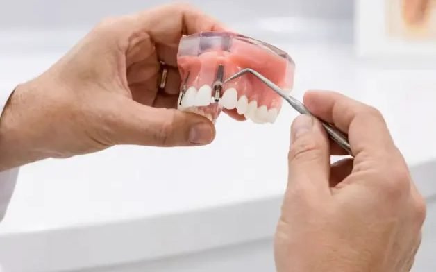 Modelo dental con implante colocado en la encía