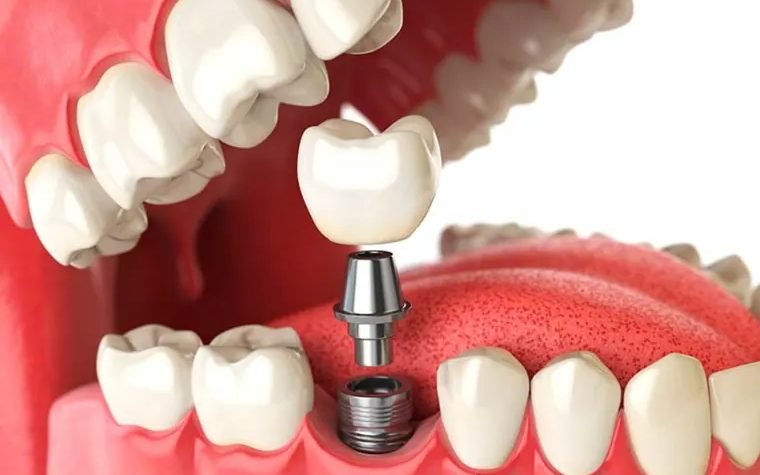 Prótesis dental removible sostenida en la mano